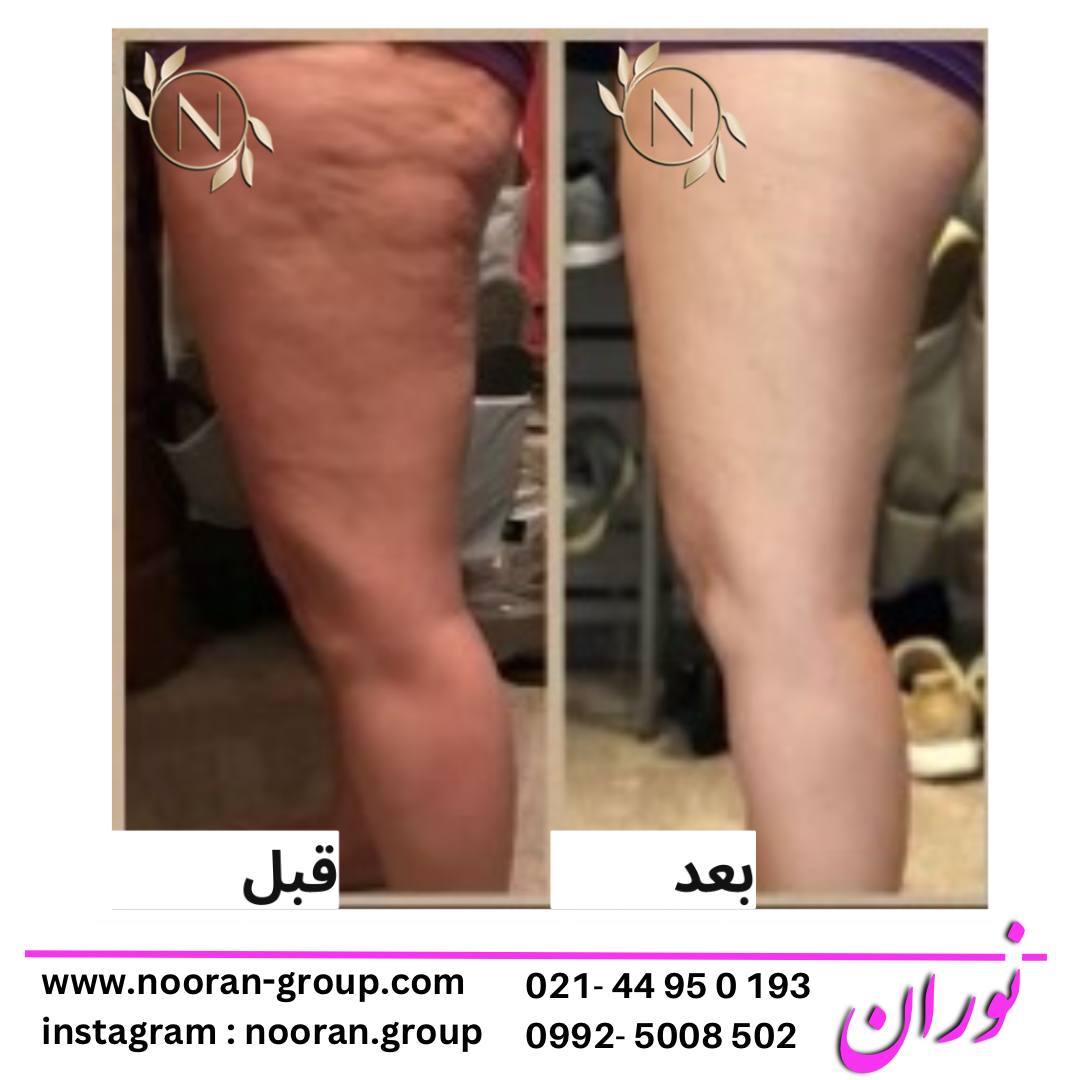 لاغری موضعی در کلینیک زیبایی و لاغری نوران به عنوان بهترین کلینیک لاغری تهران و غرب تهران