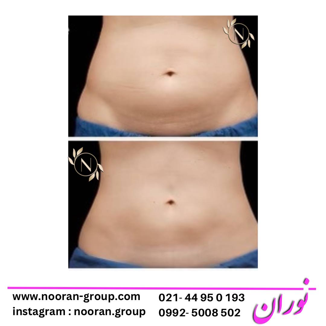 لاغری موضعی در کلینیک زیبایی و لاغری نوران به عنوان بهترین کلینیک لاغری تهران و غرب تهران