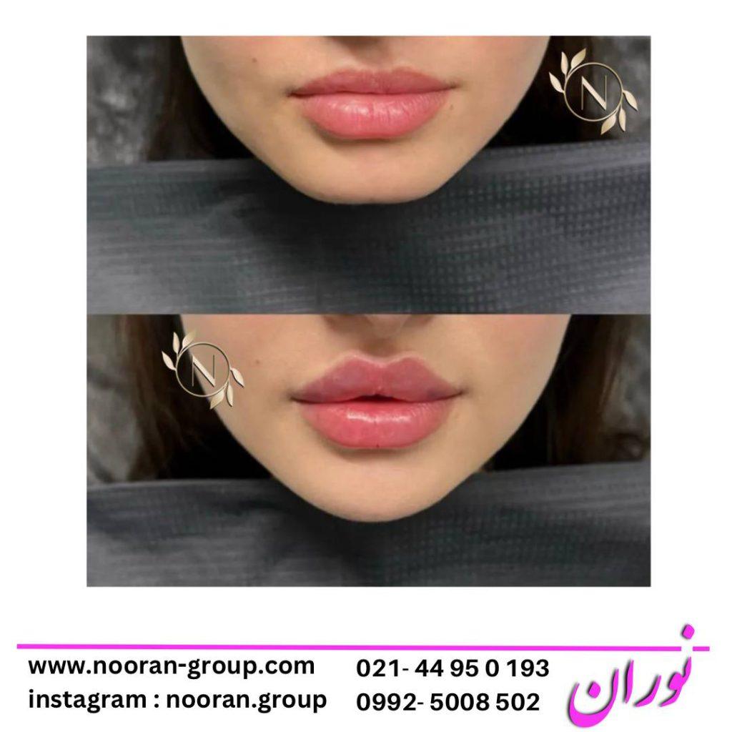 تزریق ژل لب در کلینیک زیبایی نوران