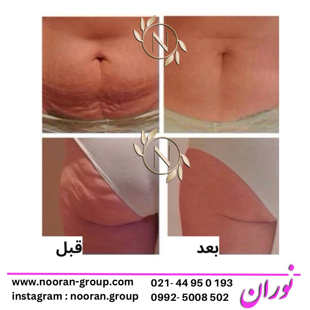 لاغری موضعی در کلینیک زیبایی و لاغری نوران به عنوان بهترین کلینیک لاغری تهران و غرب تهران