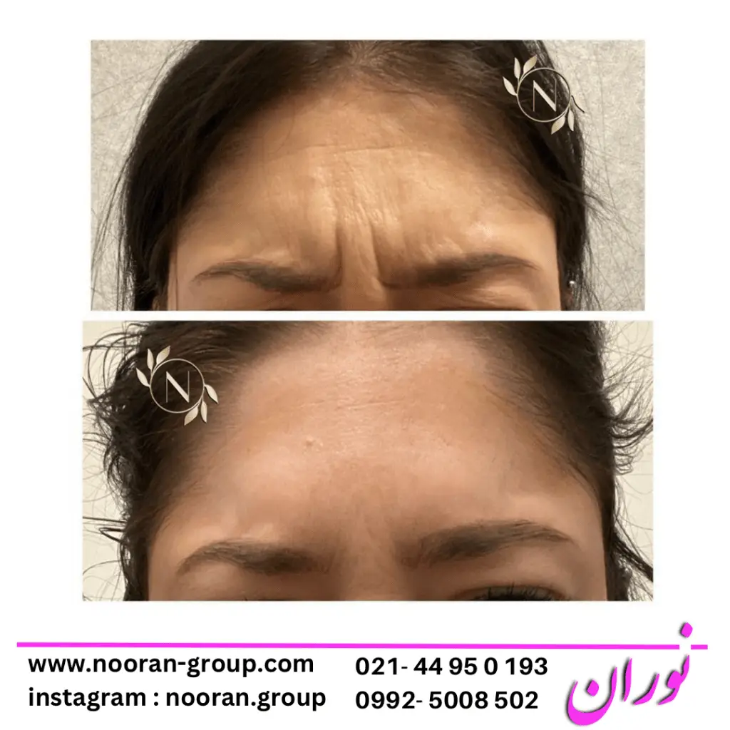 بوتاکس صورت در کلینیک زیبایی نوران