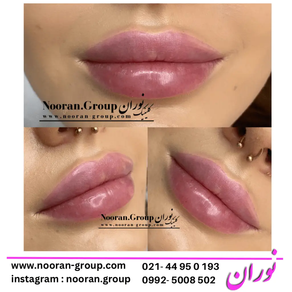 تزریق ژل لب در کلینیک زیبایی نوران - بهترین دکتر تزریق ژل لب
