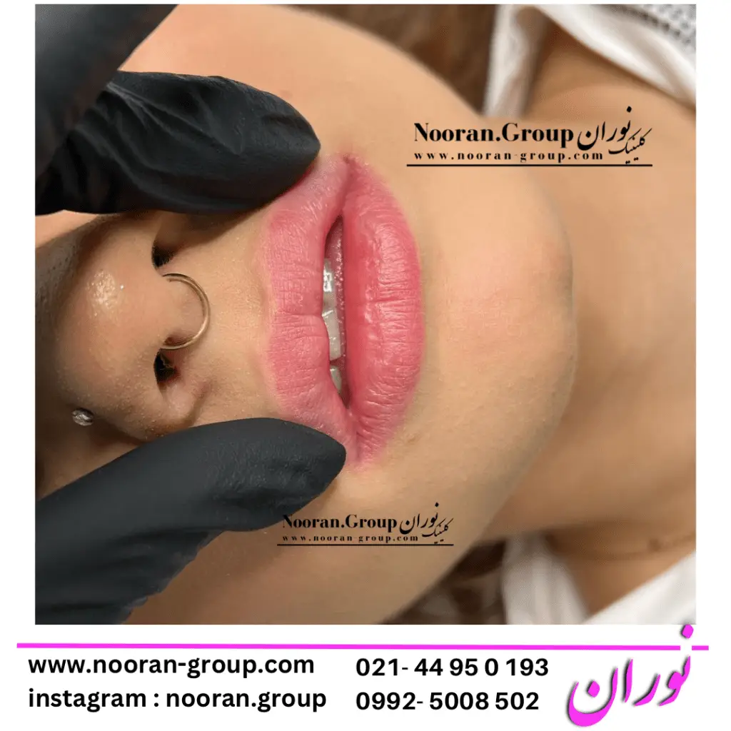 تزریق ژل لب