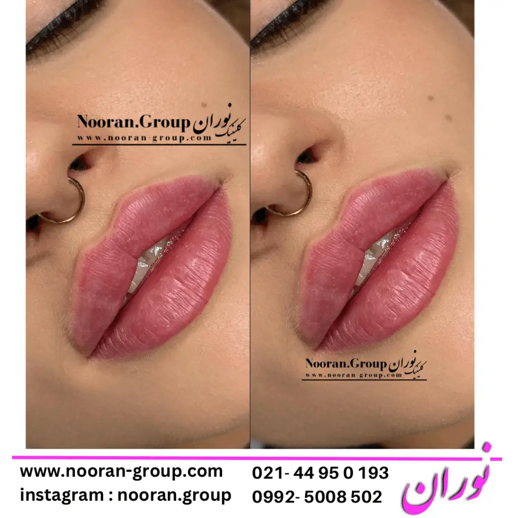 تزریق ژل لب در کلینیک زیبایی نوران - بهترین دکتر تزریق ژل لب