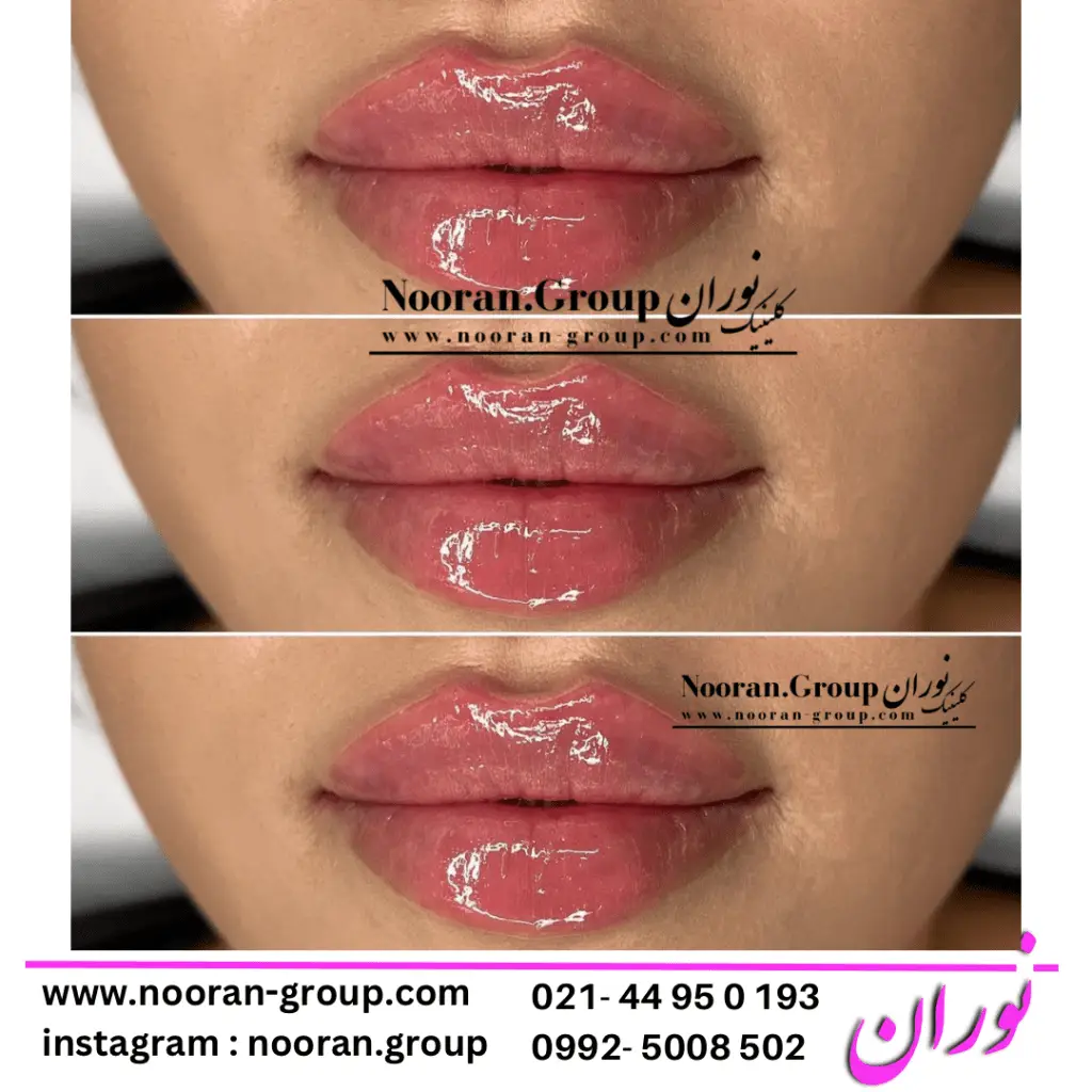 تزریق ژل لب