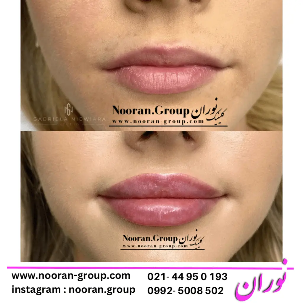 تزریق ژل لب در کلینیک زیبایی نوران - بهترین دکتر تزریق ژل لب