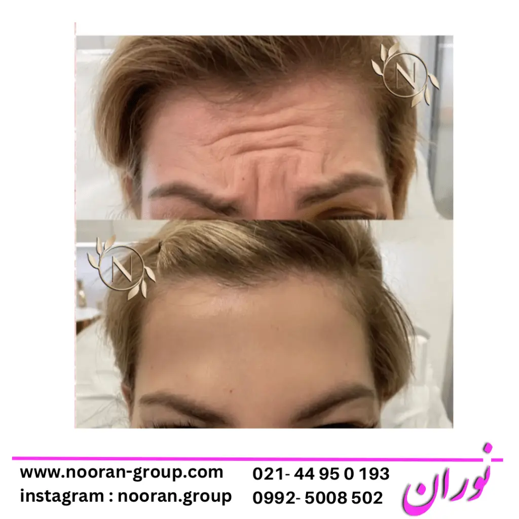 بوتاکس صورت در کلینیک زیبایی نوران