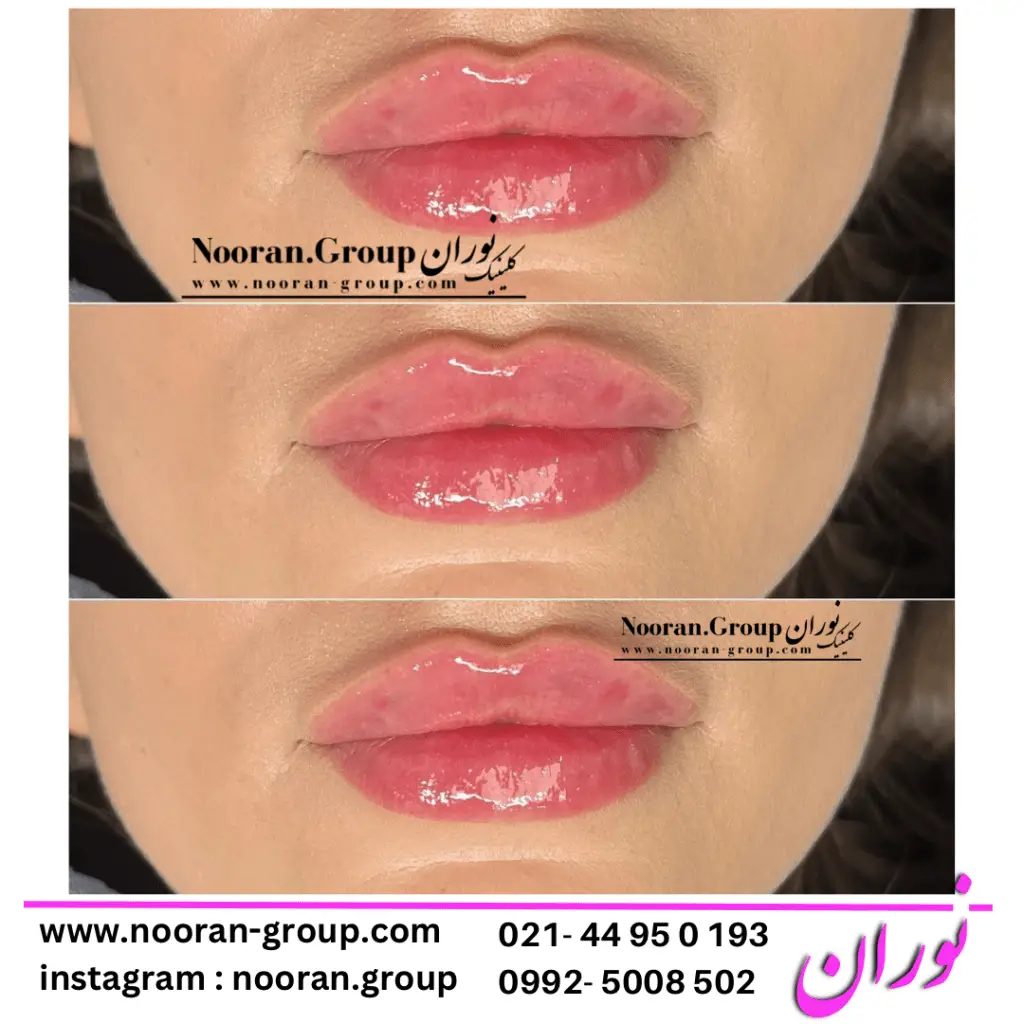تزریق ژل لب در کلینیک زیبایی نوران - بهترین دکتر تزریق ژل لب
