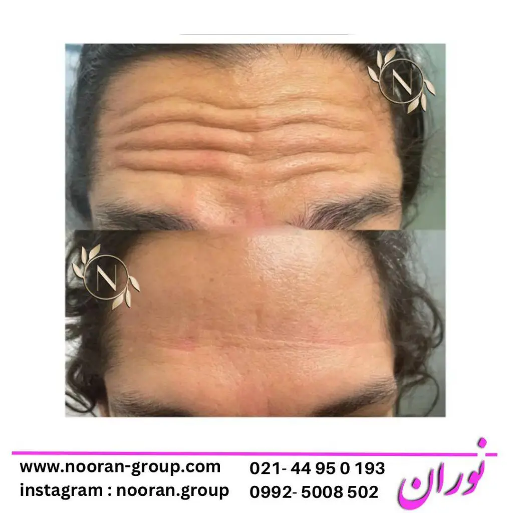 بوتاکس صورت در کلینیک زیبایی نوران