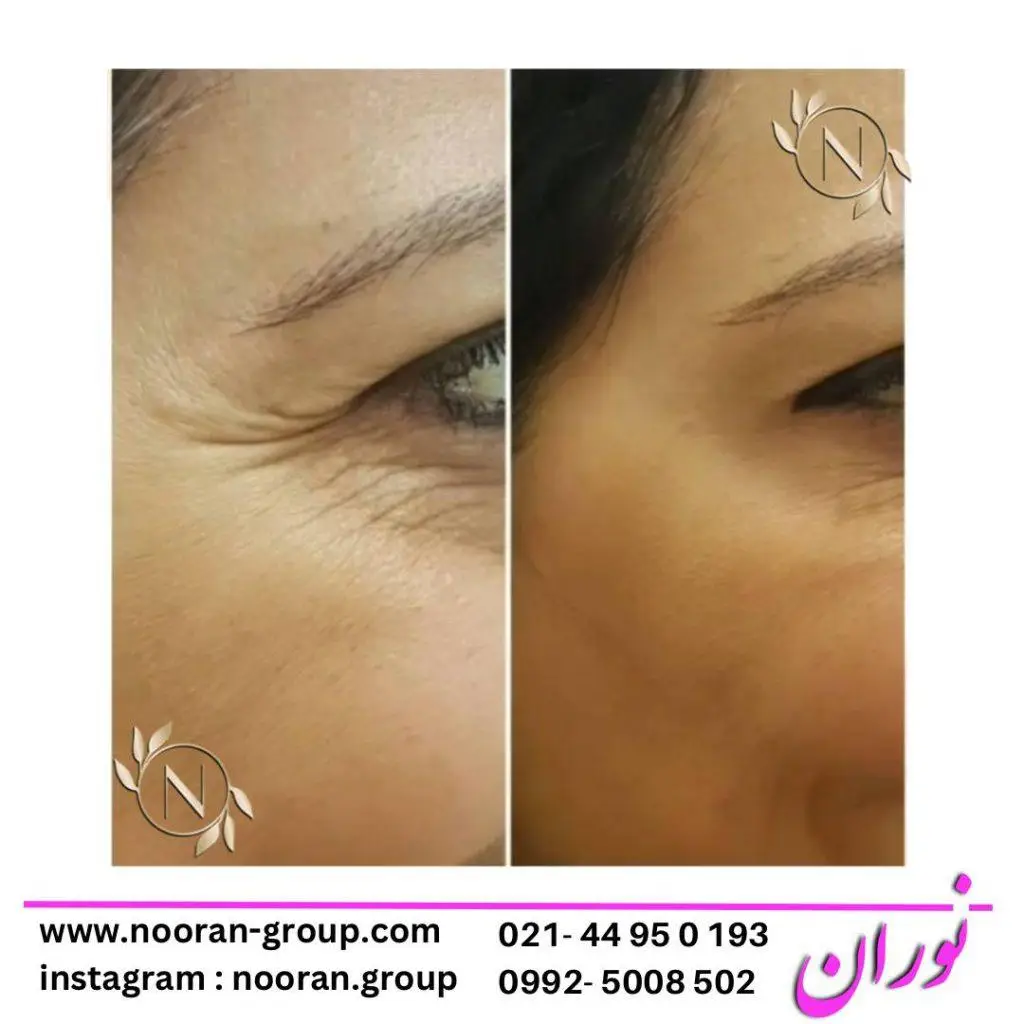 بوتاکس صورت در کلینیک زیبایی نوران