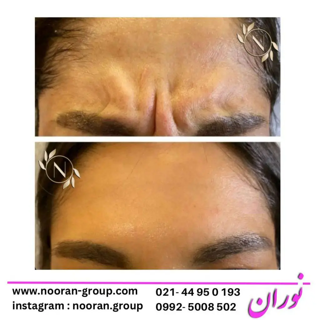 بوتاکس صورت در کلینیک زیبایی نوران