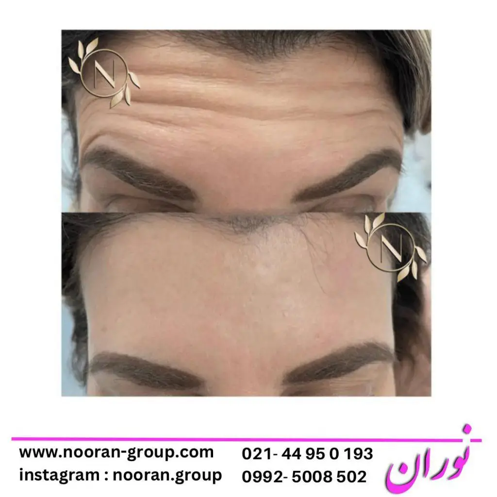 بوتاکس صورت در کلینیک زیبایی نوران
