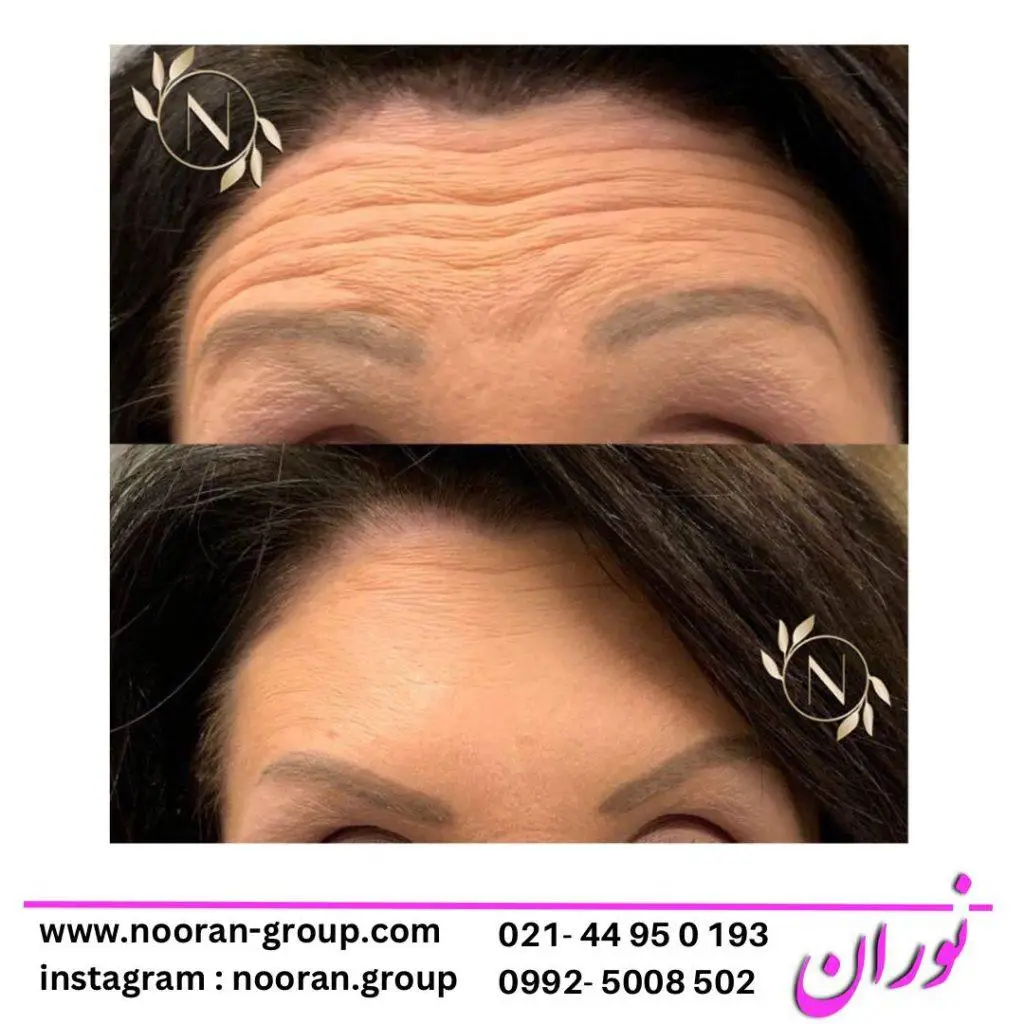 بوتاکس صورت در کلینیک زیبایی نوران