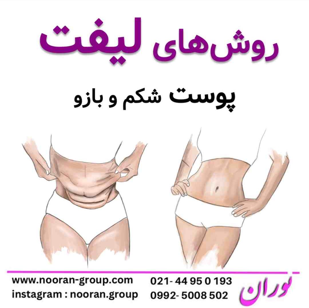 روش های لیفت پوست شکم و بازو