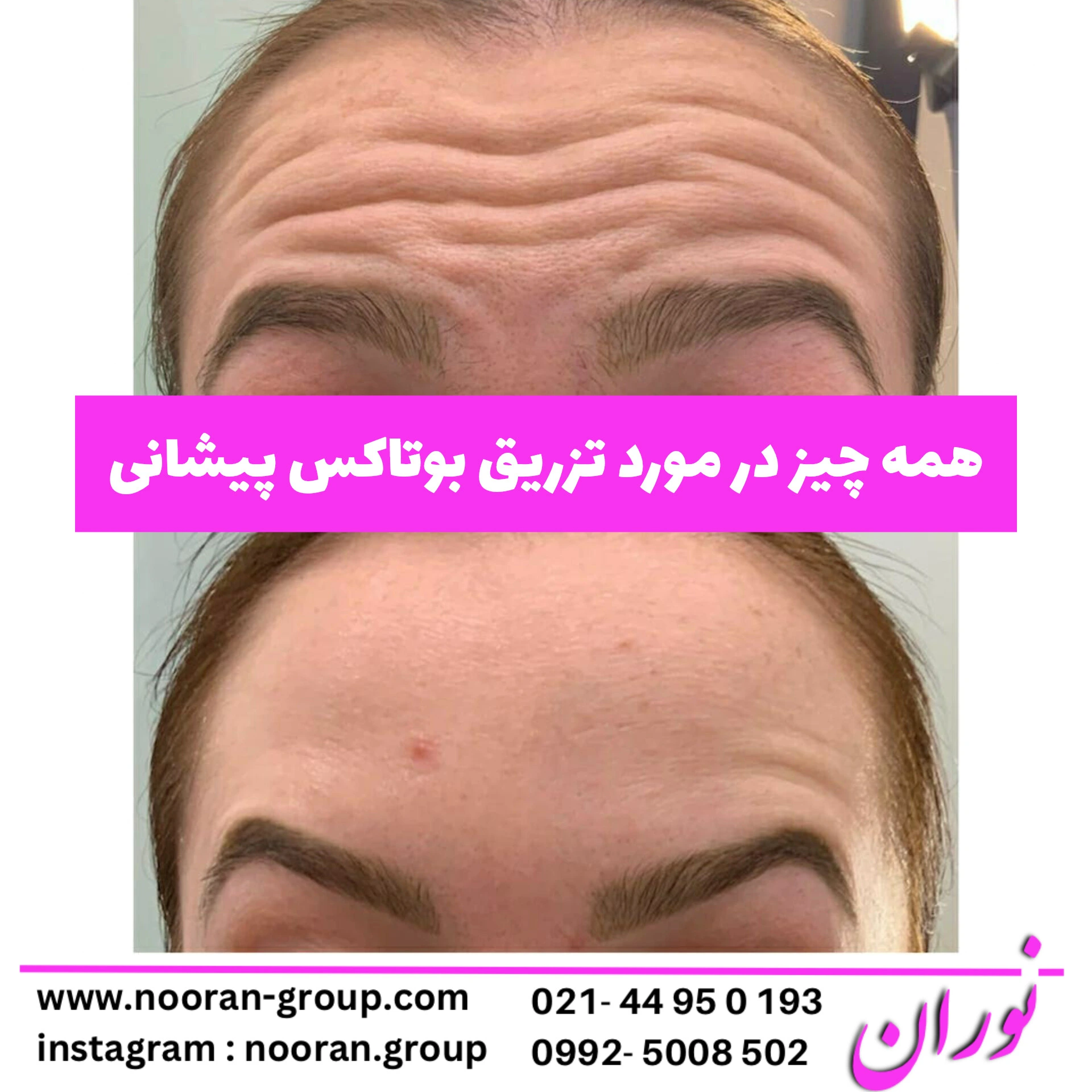 همه چیز درباره بوتاکس پیشانی
