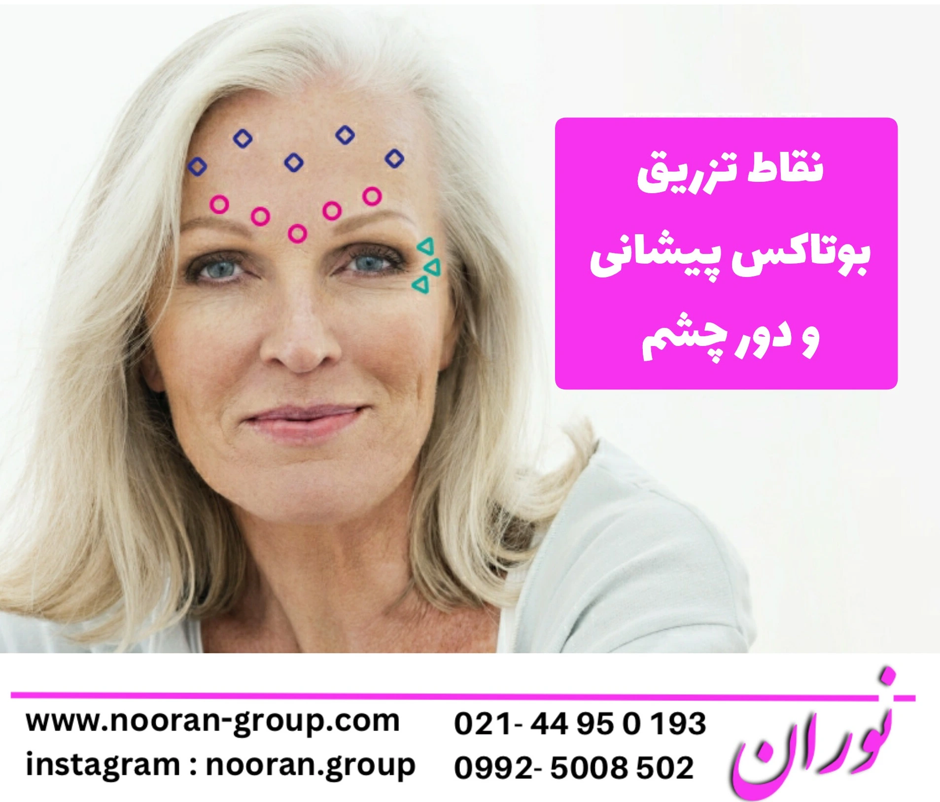 همه چیز درباره بوتاکس پیشانی