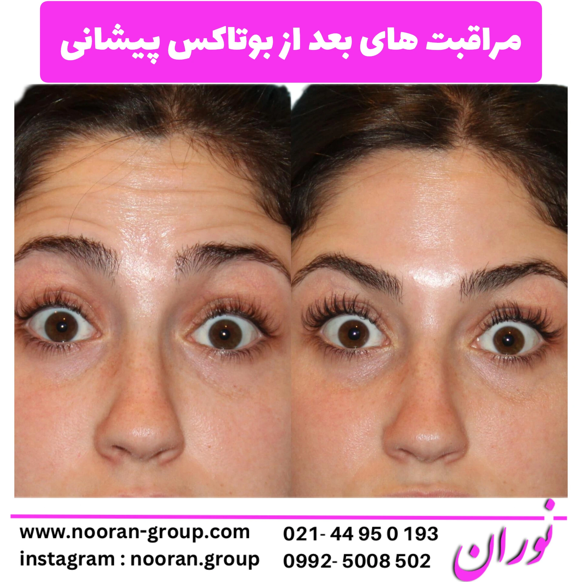 همه چیز درباره بوتاکس پیشانی