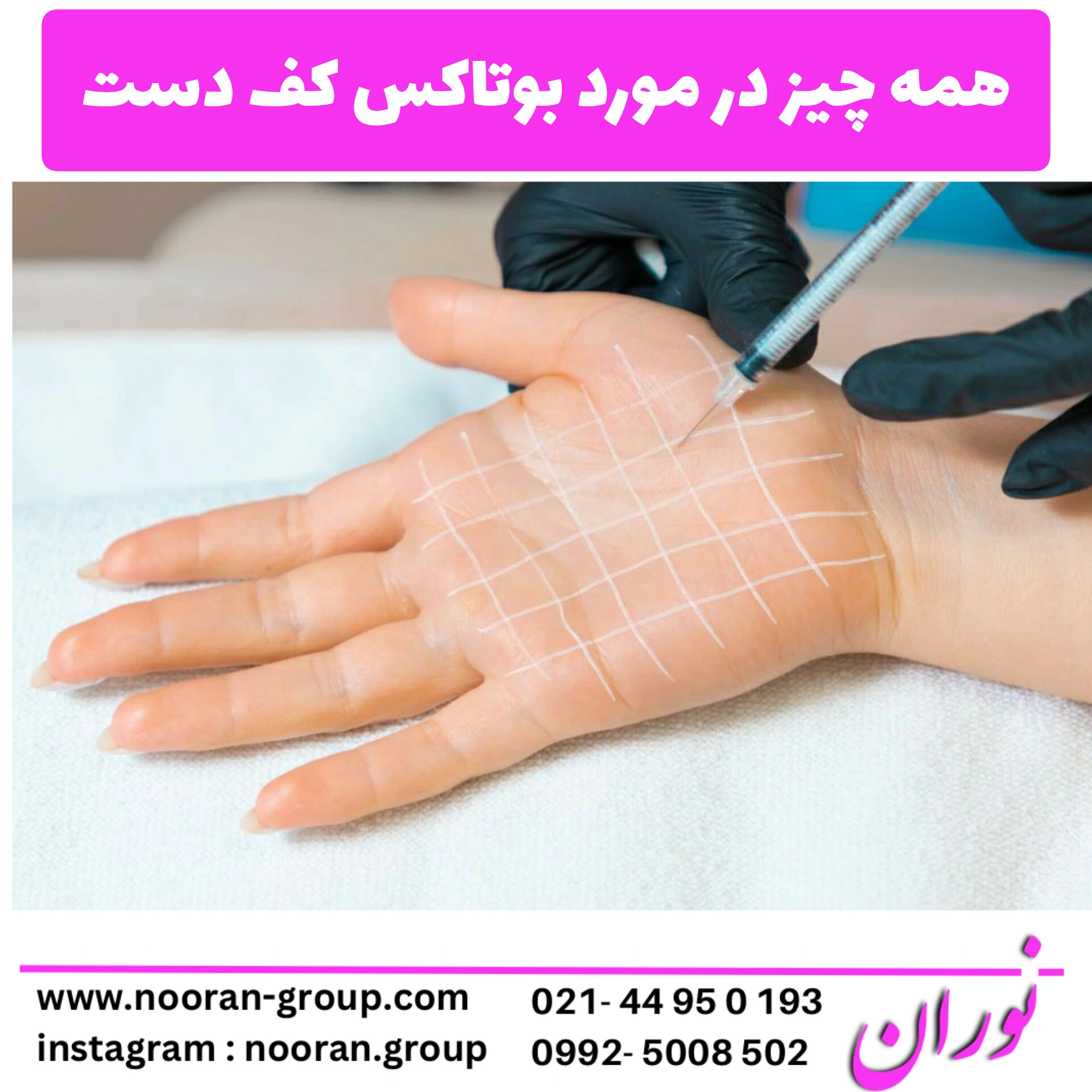 همه چیز درباره بوتاکس کف دست