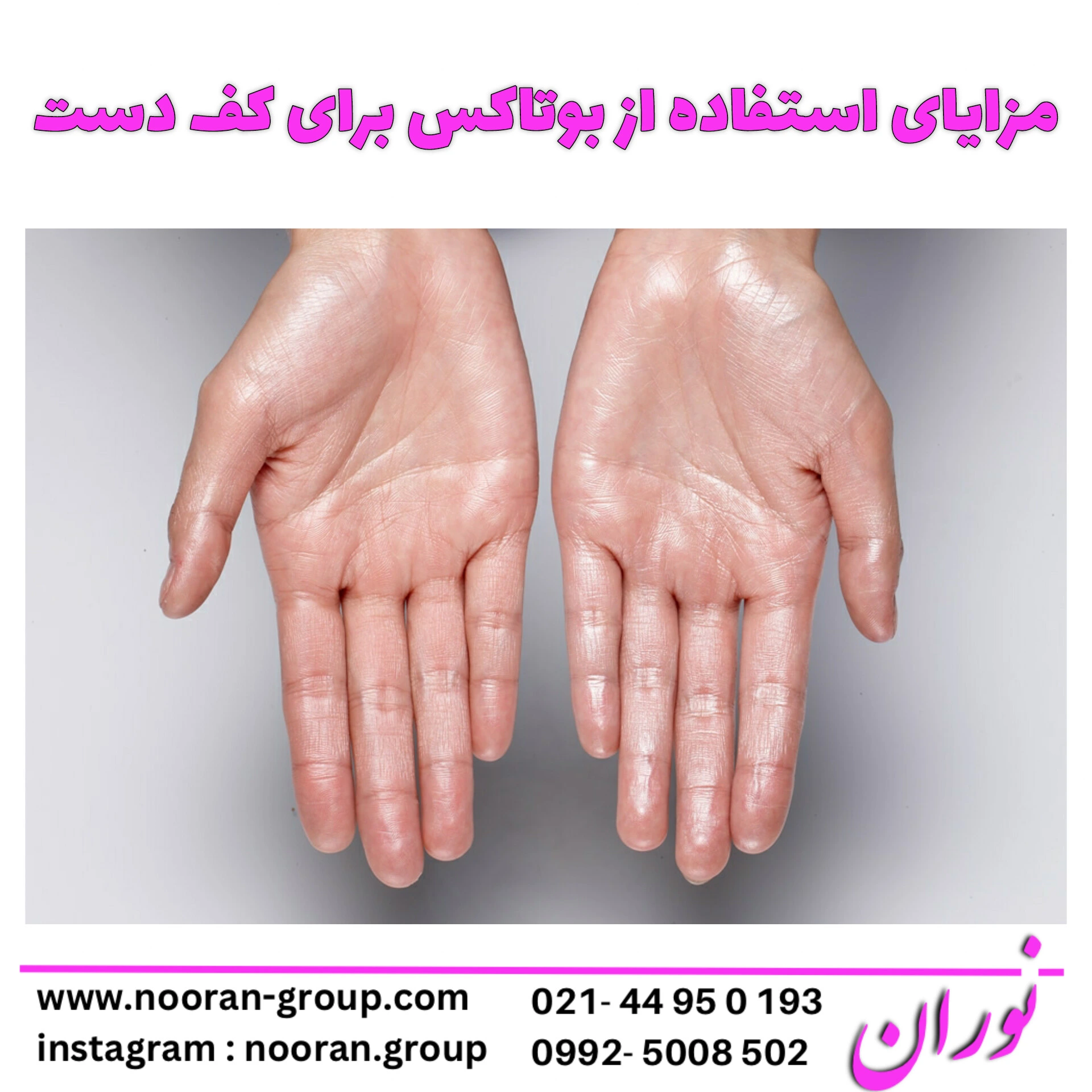 همه چیز درباره بوتاکس کف دست