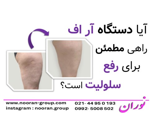 آیا دستگاه آر اف راهی مطمئن برای رفع سلولیت است؟