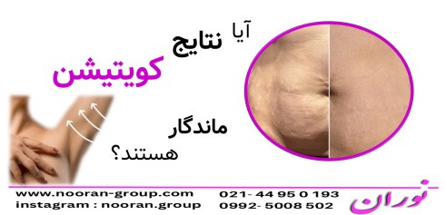 آیا نتایج کویتیشن ماندگار هستند؟
