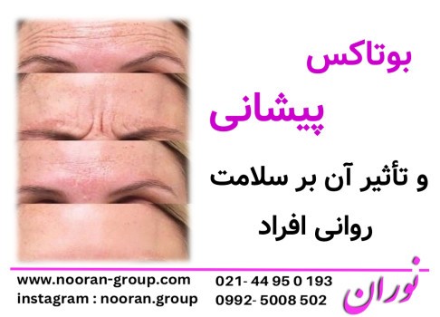 بوتاکس پیشانی و تأثیر آن بر سلامت روانی افراد