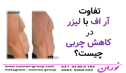 تفاوت آر اف با لیزر در کاهش چربی چیست؟