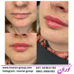 عوارض احتمالی مزوژل صورت