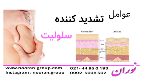 عوامل تشدیدکننده سلولیت