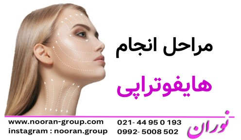 مراحل انجام هایفوتراپی