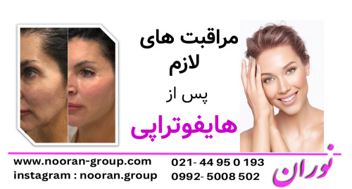 مراقبت‌های لازم پس از هایفوتراپی