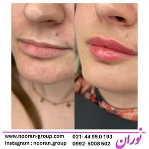 مزایای استفاده از مزوژل صورت