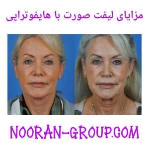 مزایای لیفت صورت با هایفوتراپی