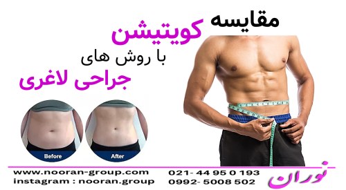 مقایسه کویتیشن با روش‌های جراحی لاغری