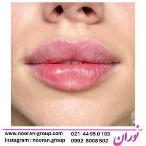 نظرات درباره مزوژل صورت