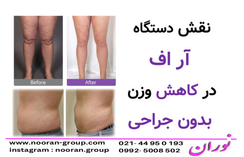 نقش دستگاه آر اف در کاهش وزن بدون جراحی