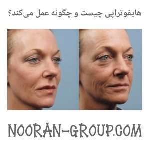 هایفوتراپی چیست و چگونه عمل می‌کند؟