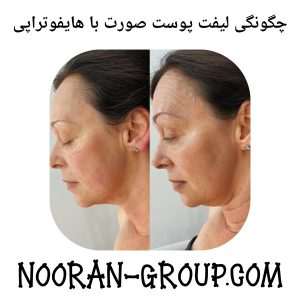 چگونگی لیفت پوست صورت با هایفوتراپی