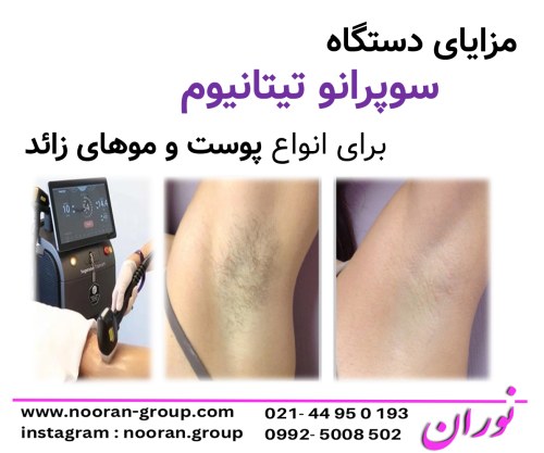 مزایای دستگاه سوپرانو تیتانیوم برای انواع پوست و موهای زائد