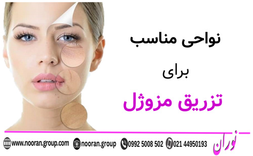 نواحی مناسب برای تزریق مزوژل