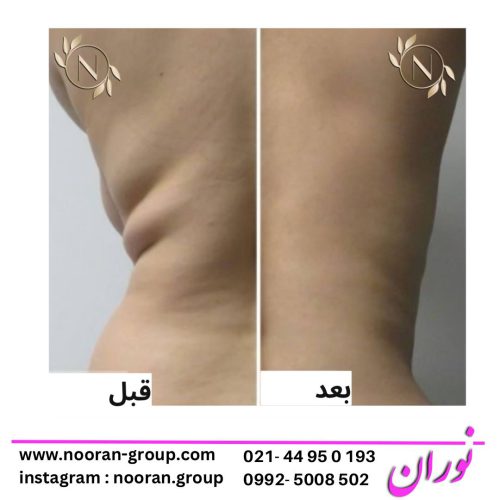 لاغری موضعی در کلینیک زیبایی و لاغری نوران به عنوان بهترین کلینیک لاغری تهران و غرب تهران لاغری موضعی در کلینیک زیبایی و لاغری نوران به عنوان بهترین کلینیک لاغری تهران و غرب تهران