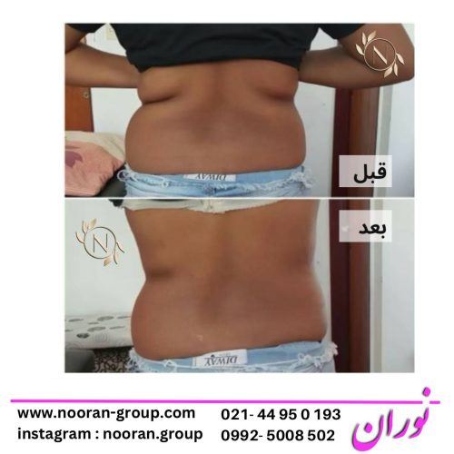 لاغری شکم و پهلو با دستگاه در کلینیک نوران لاغری شکم و پهلو با دستگاه در کلینیک نوران