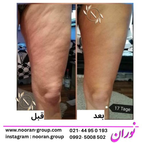 رفع سلولیت با دستگاه رفع سلولیت با دستگاه