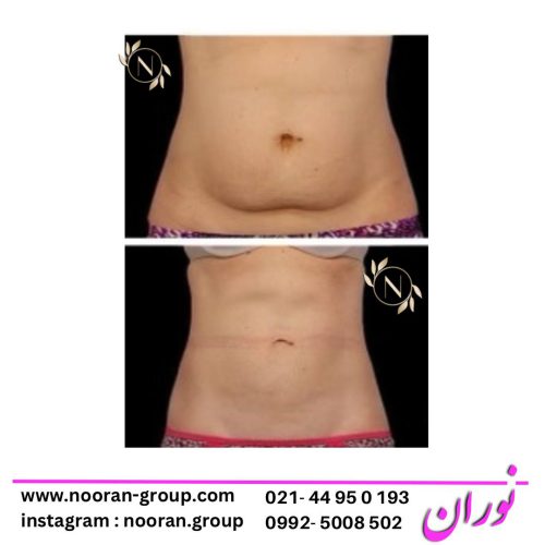 لاغری شکم و پهلو با دستگاه در کلینیک نوران لاغری شکم و پهلو با دستگاه در کلینیک نوران